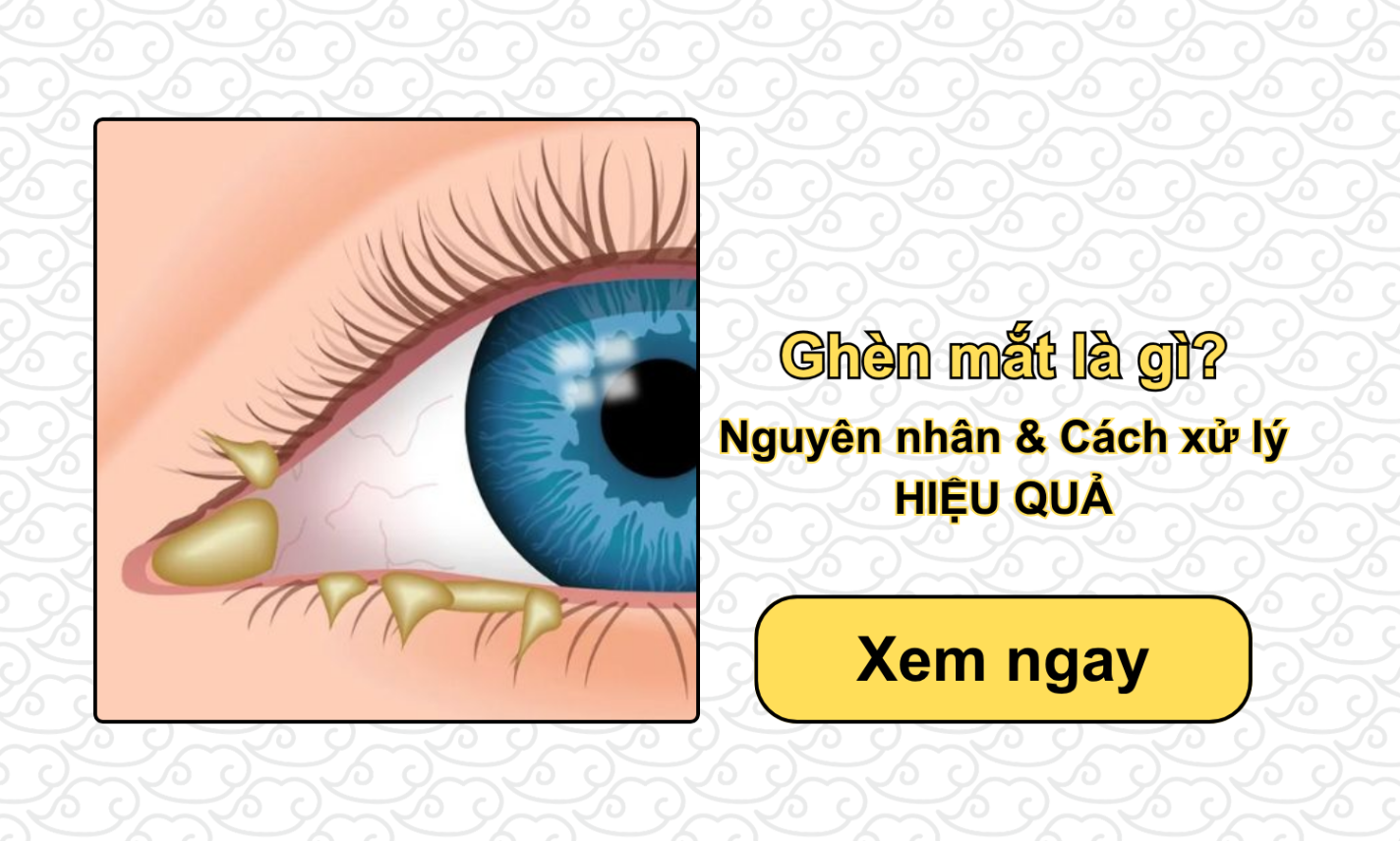 Ghèn mắt là gì? Nguyên nhân & Cách xử lý HIỆU QUẢ