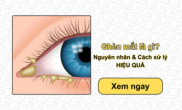 Ghèn mắt là gì? Nguyên nhân & Cách xử lý HIỆU QUẢ
