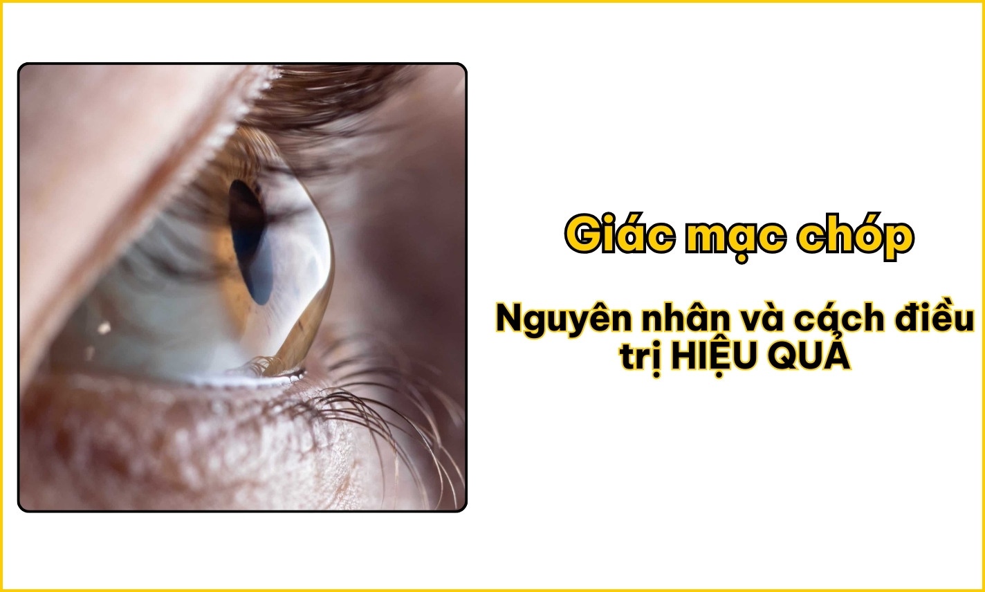 Giác mạc chóp: Nguyên nhân và cách điều trị HIỆU QUẢ