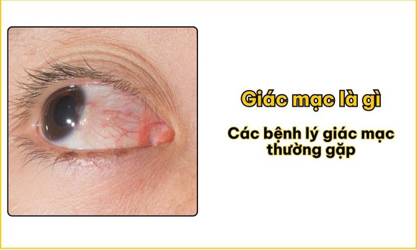 Giác mạc là gì và các bệnh lý giác mạc thường gặp