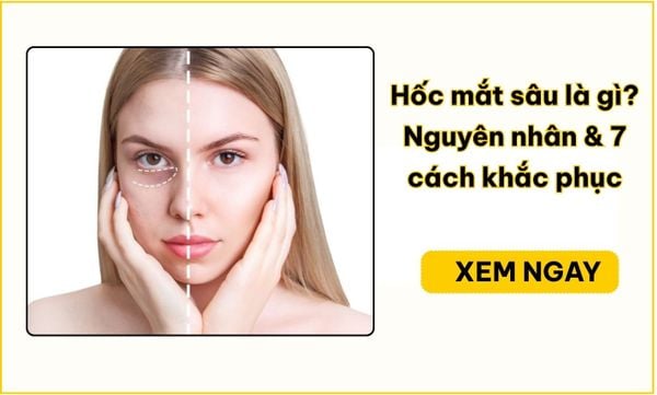 Hốc mắt sâu là gì? Nguyên nhân & 7 cách khắc phục