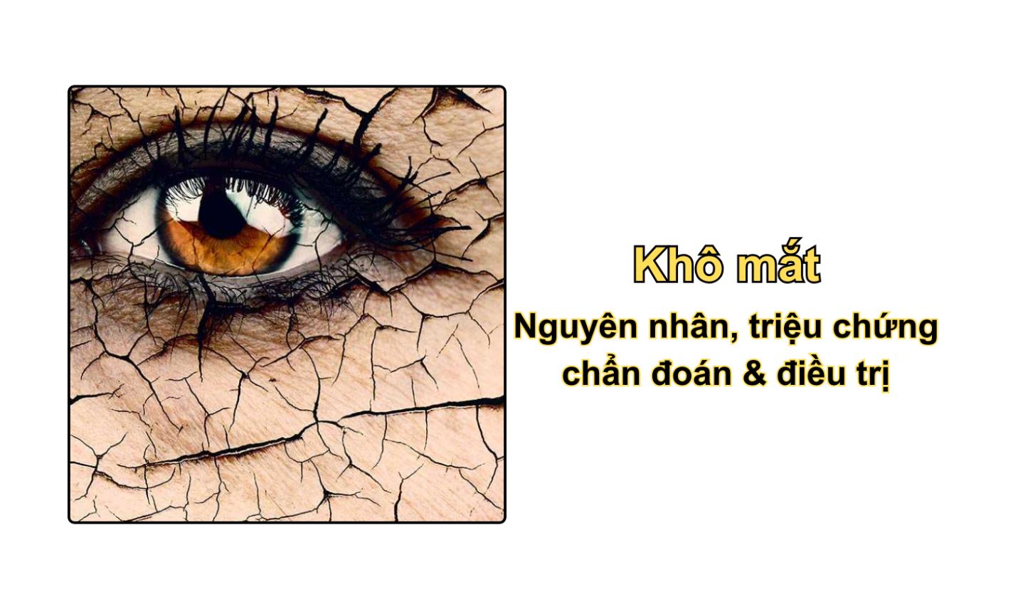 Khô mắt: Nguyên nhân, triệu chứng, chẩn đoán & điều trị