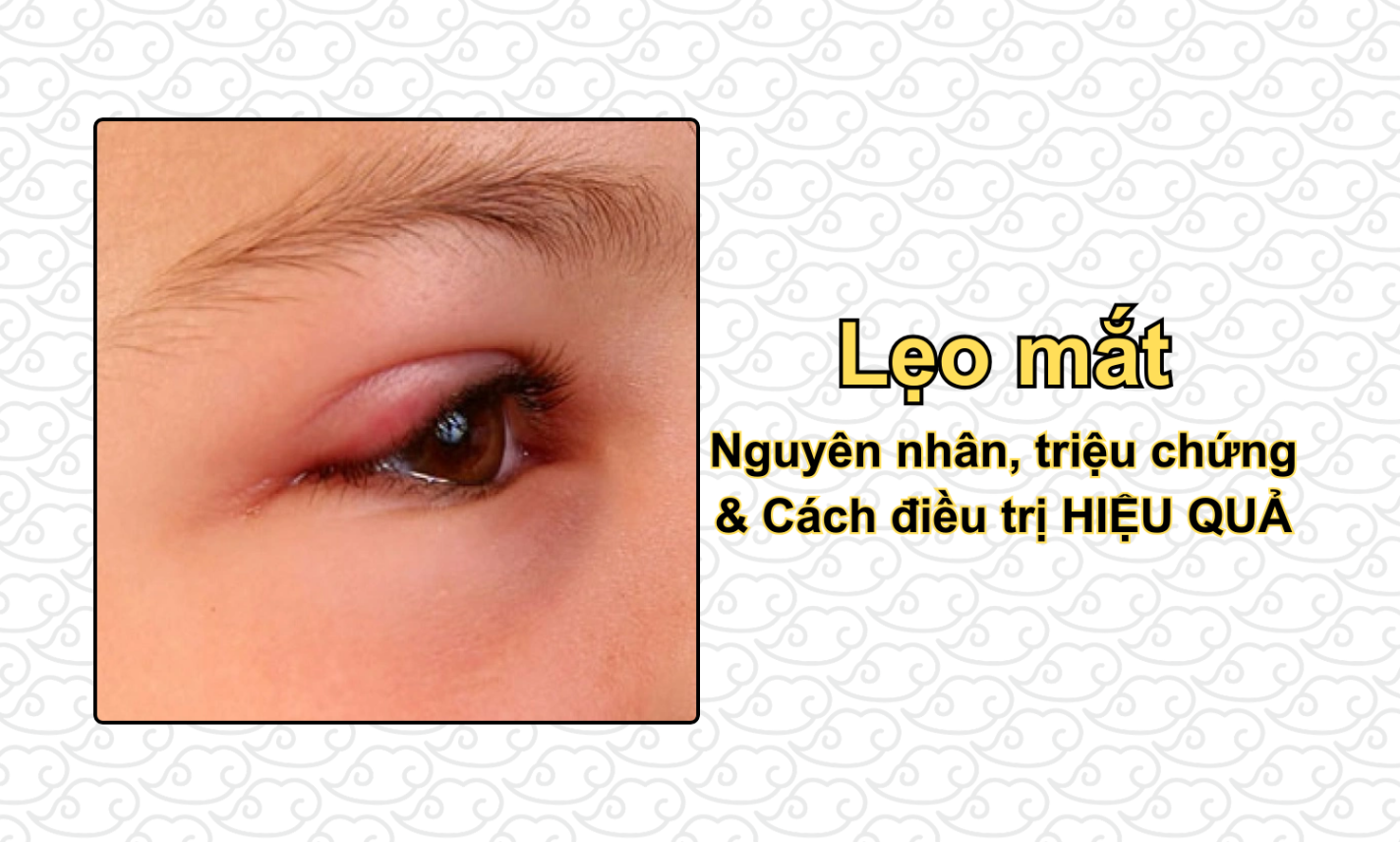Lẹo mắt: Nguyên nhân, triệu chứng & Cách điều trị HIỆU QUẢ