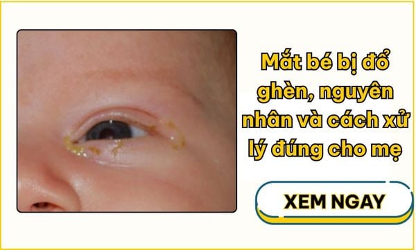 Mắt bé bị đổ ghèn, nguyên nhân và cách xử lý đúng cho mẹ
