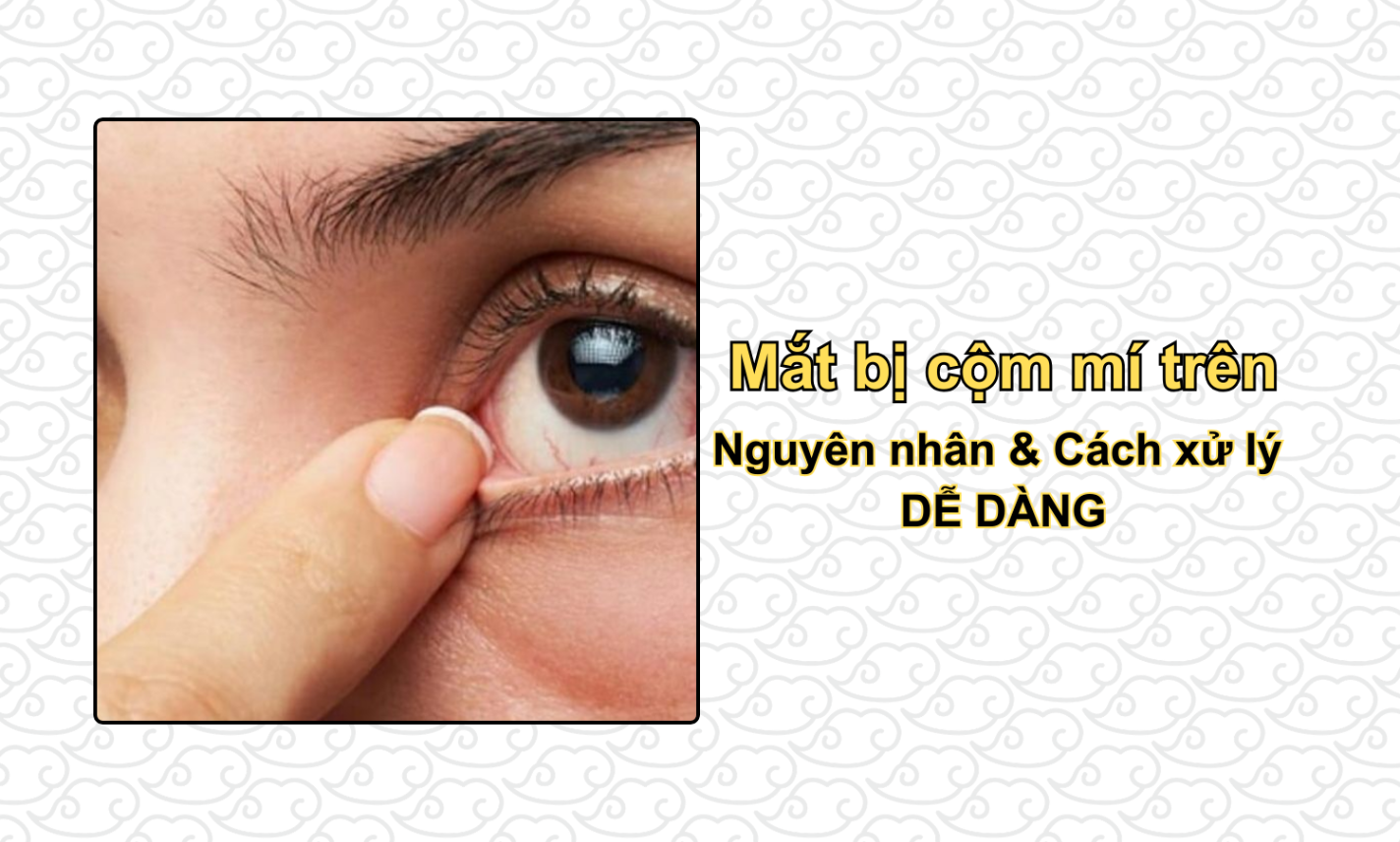 Mắt bị cộm mí trên: Nguyên nhân & Cách xử lý DỄ DÀNG