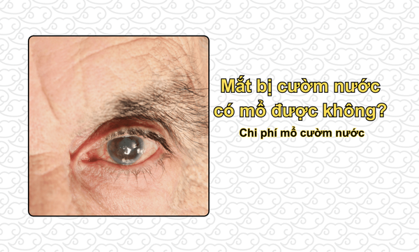 Mắt bị cườm nước có mổ được không? Chi phí mổ cườm nước