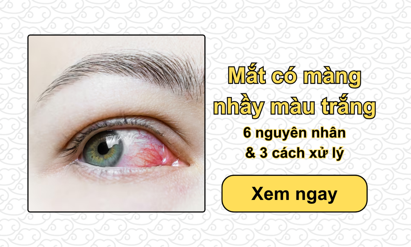 Mắt có màng nhầy màu trắng: 6 nguyên nhân & 3 cách xử lý