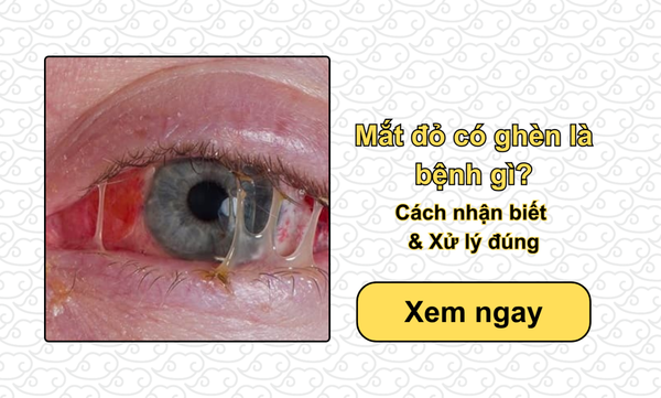 Mắt đỏ có ghèn là bệnh gì? Cách nhận biết & Xử lý đúng