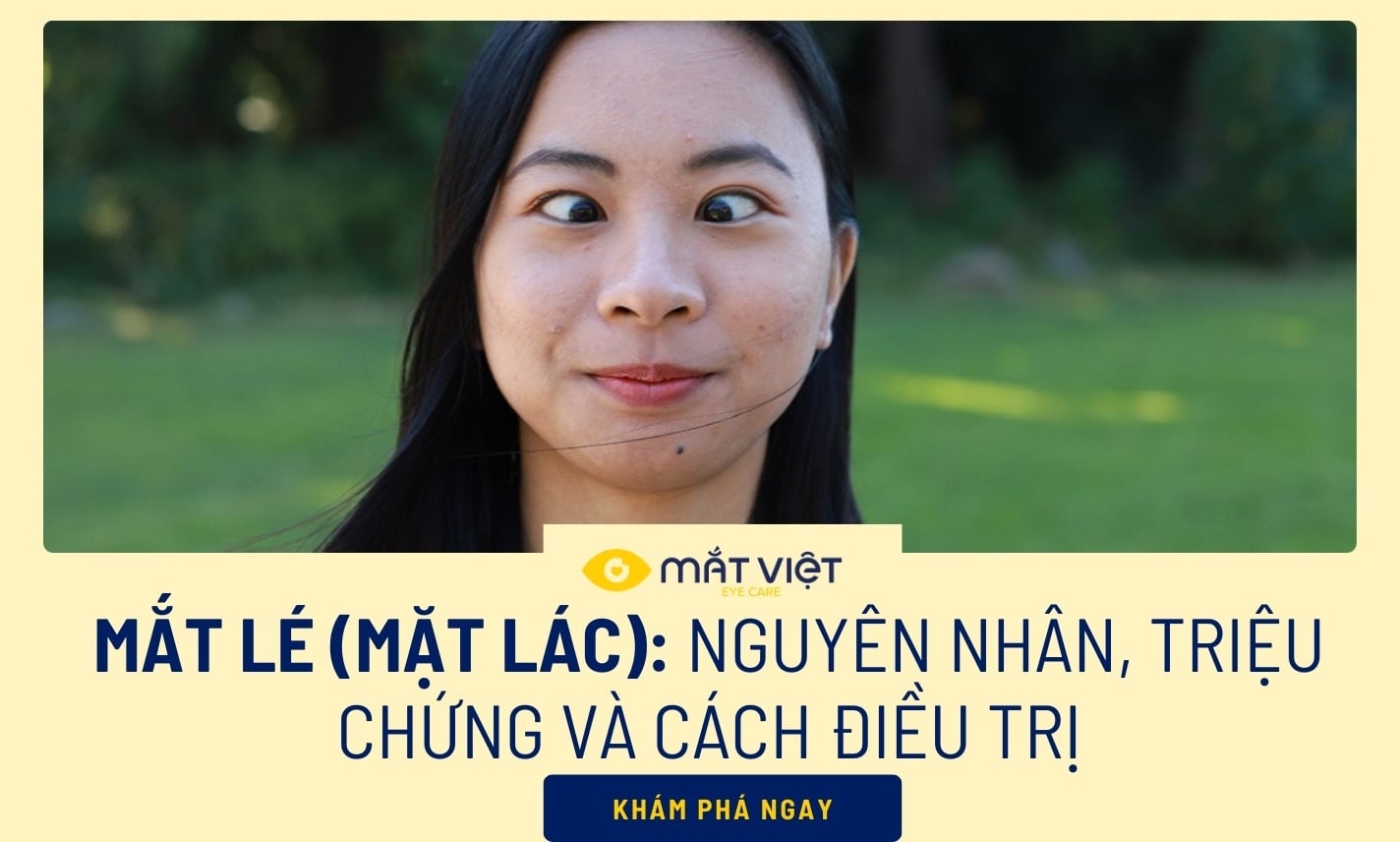 Mắt lé (mắt lác): Nguyên nhân, triệu chứng và cách điều trị