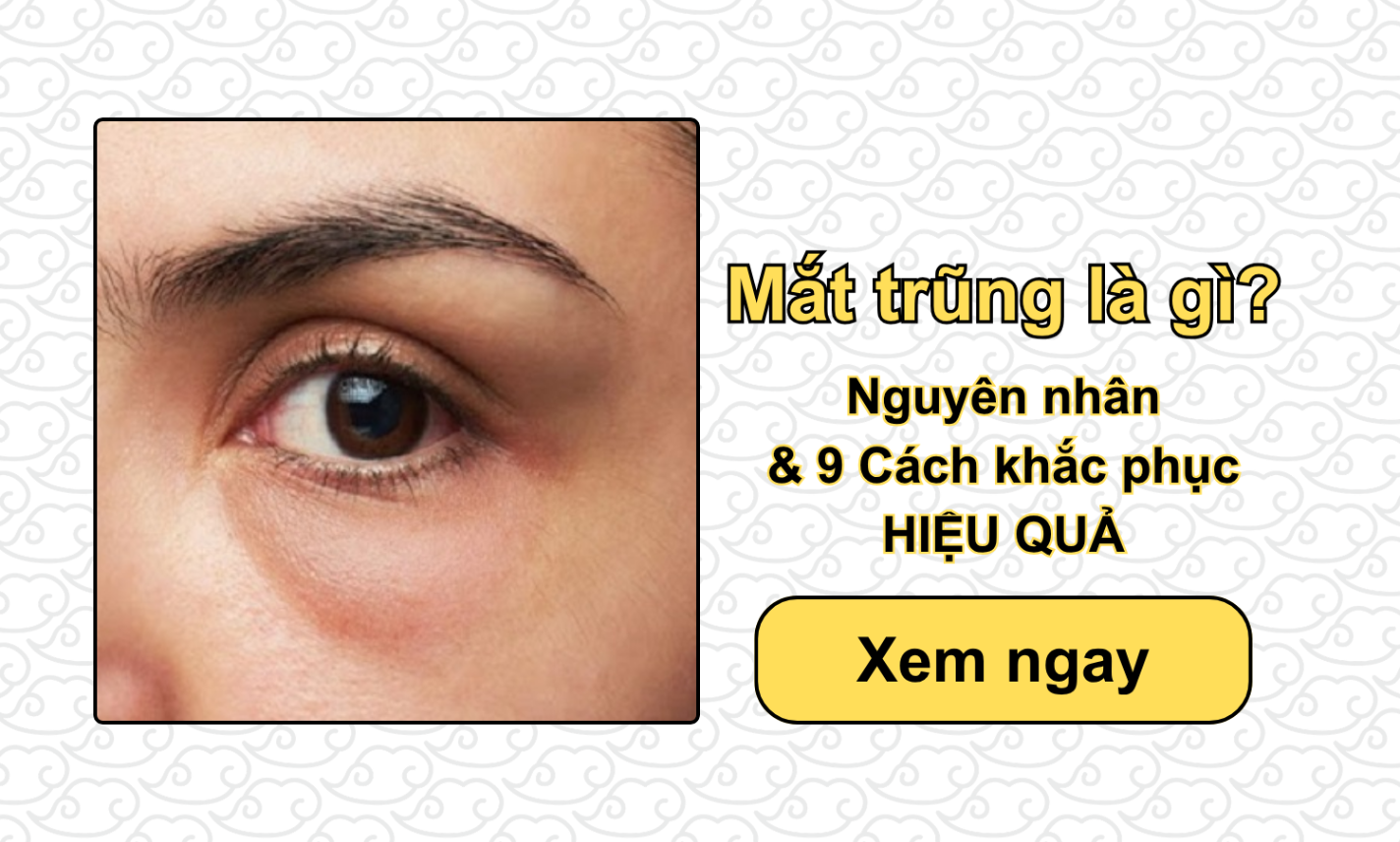 Mắt trũng là gì? Nguyên nhân & 9 Cách khắc phục HIỆU QUẢ
