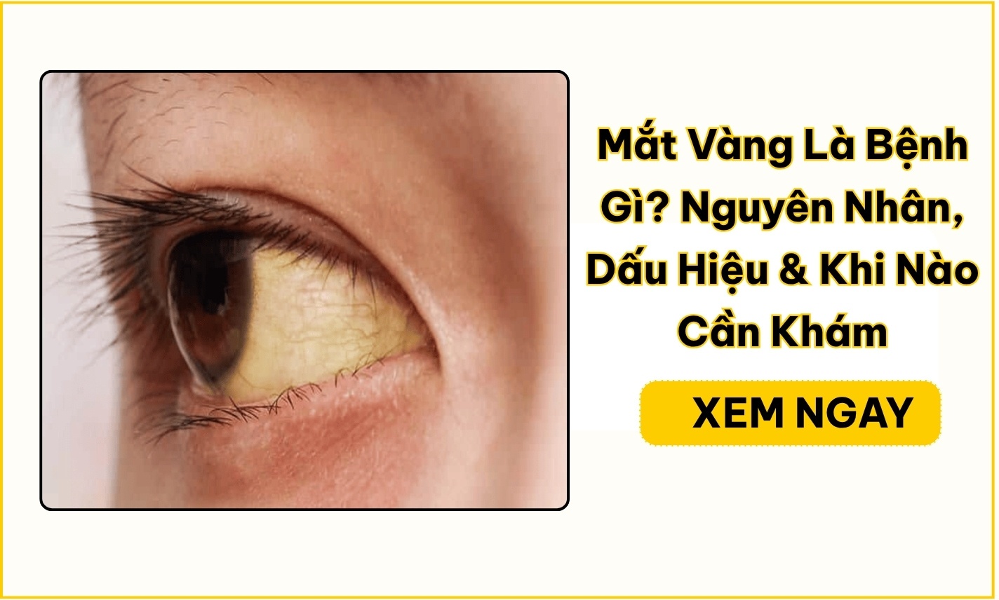 Mắt Vàng Là Bệnh Gì? Nguyên Nhân & Khi Nào Cần Đi Khám