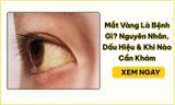 Mắt Vàng Là Bệnh Gì? Nguyên Nhân & Khi Nào Cần Đi Khám