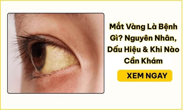 Mắt Vàng Là Bệnh Gì? Nguyên Nhân & Khi Nào Cần Đi Khám
