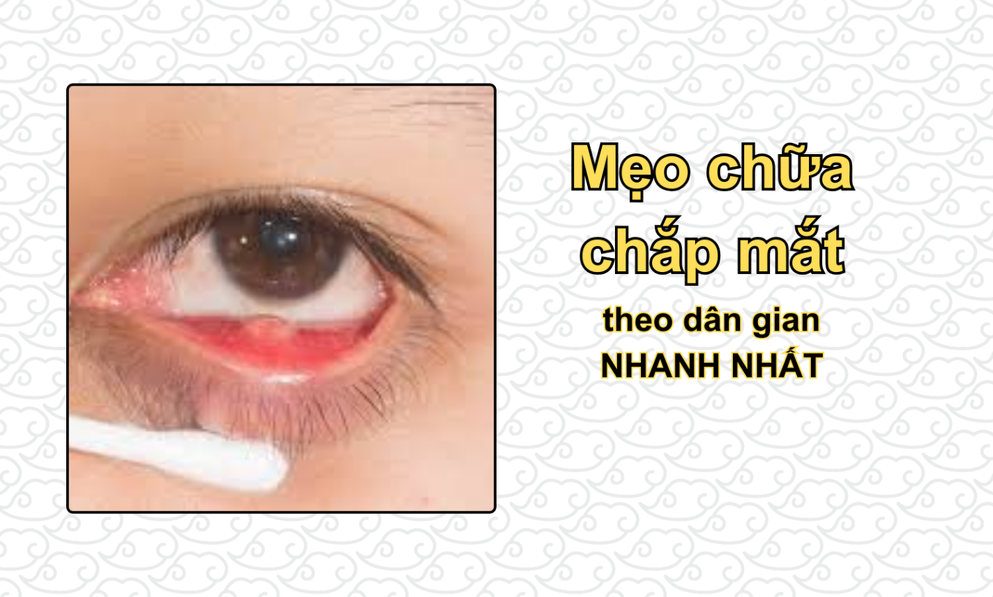 Những mẹo chữa chắp mắt theo dân gian NHANH NHẤT
