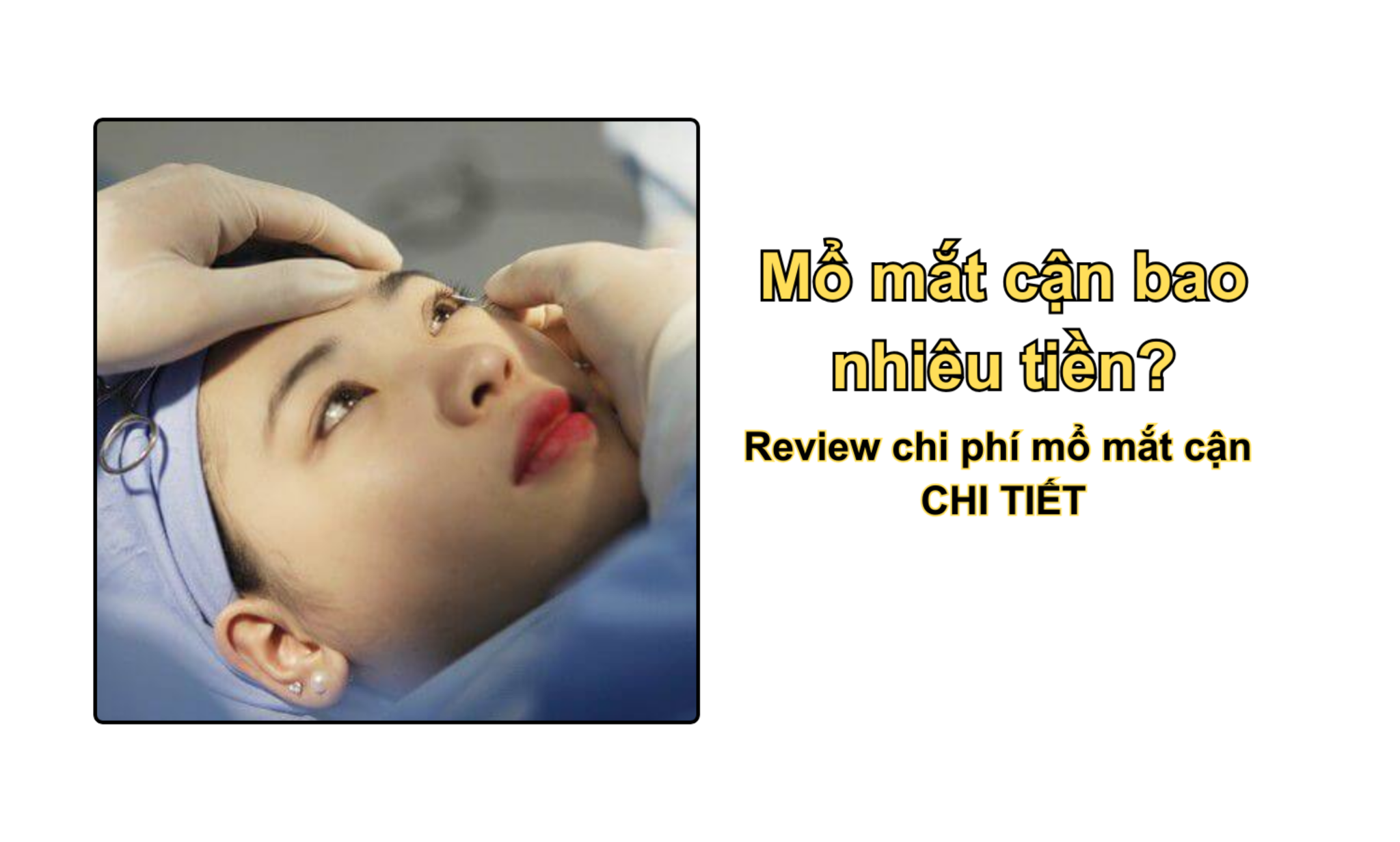 Mổ mắt cận bao nhiêu tiền? Review chi phí mổ mắt cận CHI TIẾT