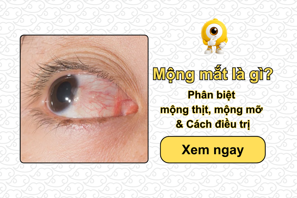 Mộng mắt là gì? Phân biệt mộng thịt, mộng mỡ mắt & Cách điều trị