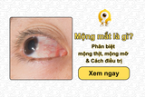 Mộng mắt là gì? Phân biệt mộng thịt, mộng mỡ mắt & Cách điều trị