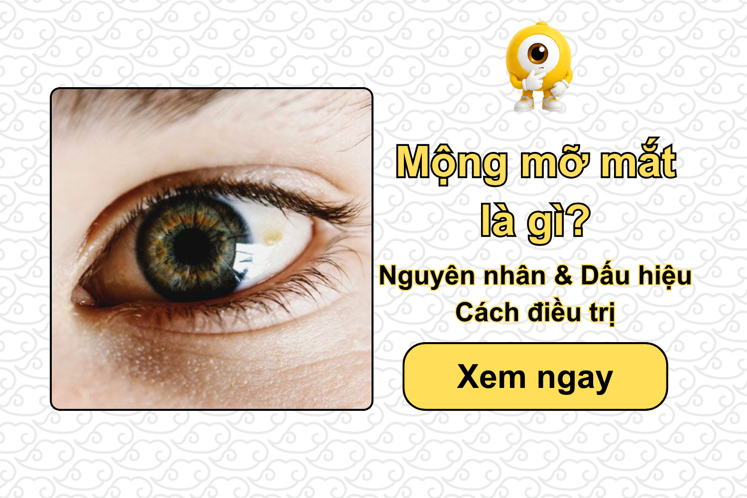 Mộng mỡ mắt là gì? Nguyên nhân, dấu hiệu & Cách điều trị