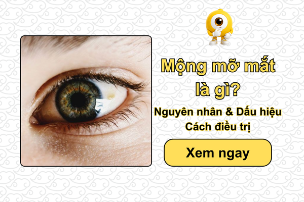 Mộng mỡ mắt là gì? Nguyên nhân, dấu hiệu & Cách điều trị