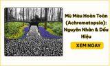 Mù Màu Hoàn Toàn (Achromatopsia): Nguyên Nhân & Dấu Hiệu