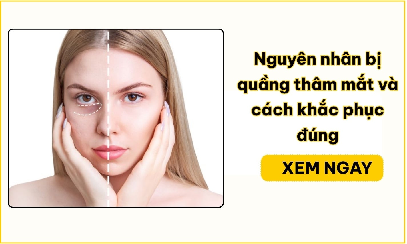 Nguyên nhân bị quầng thâm mắt và cách khắc phục đúng