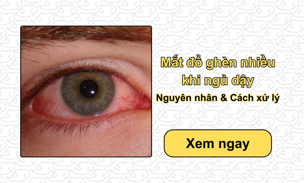 Mắt đổ ghèn nhiều khi ngủ dậy: Nguyên nhân & Cách xử lý