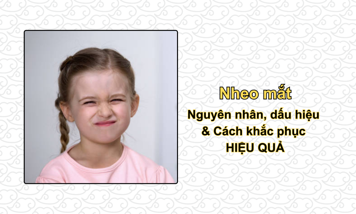 Nheo mắt: Nguyên nhân, dấu hiệu & Cách khắc phục HIỆU QUẢ