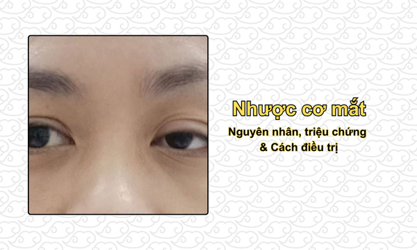 Nhược cơ mắt: Nguyên nhân, triệu chứng & Cách điều trị