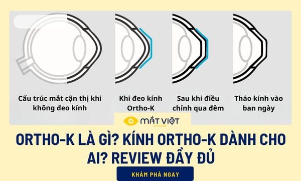 Ortho-K là gì? Kính Ortho-K dành cho ai? Review đầy đủ