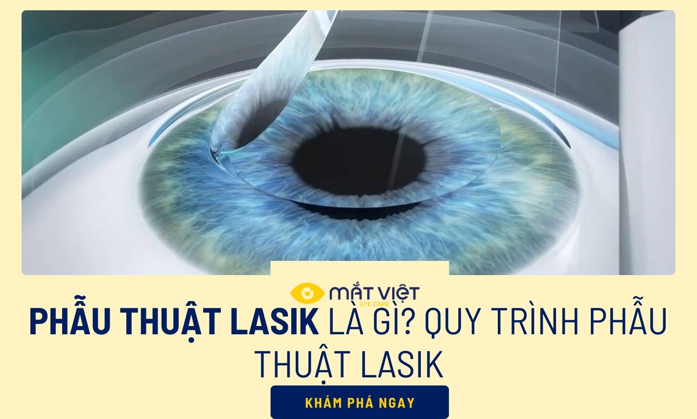 Phẫu thuật Lasik là gì? Quy trình phẫu thuật Lasik