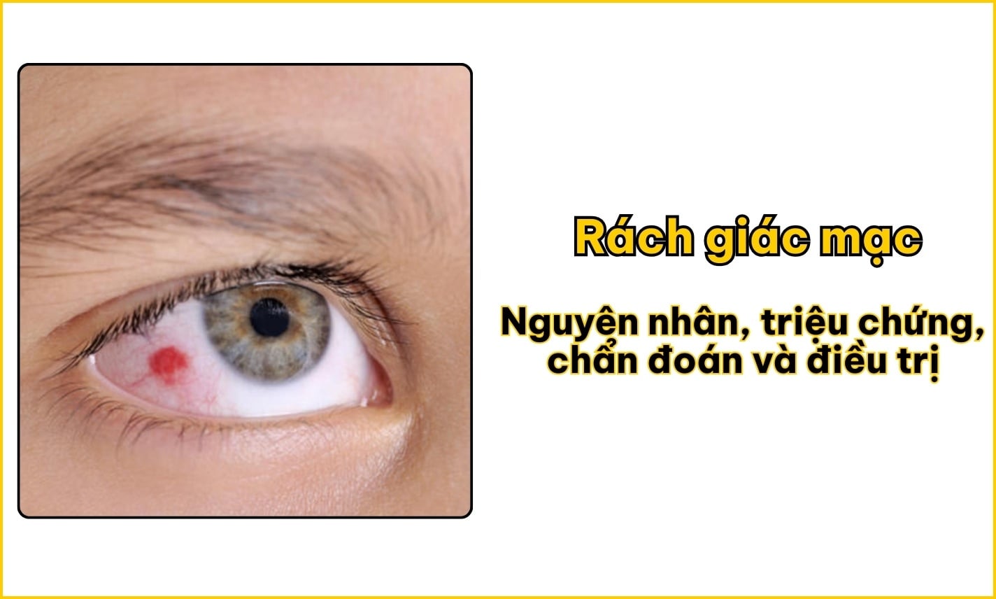 Rách giác mạc: Nguyên nhân, triệu chứng, chẩn đoán, điều trị