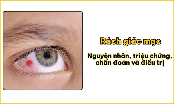 Rách giác mạc: Nguyên nhân, triệu chứng, chẩn đoán, điều trị
