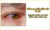 Rối loạn điều tiết mắt là gì? Nguyên nhân và cách khắc phục hiệu quả
