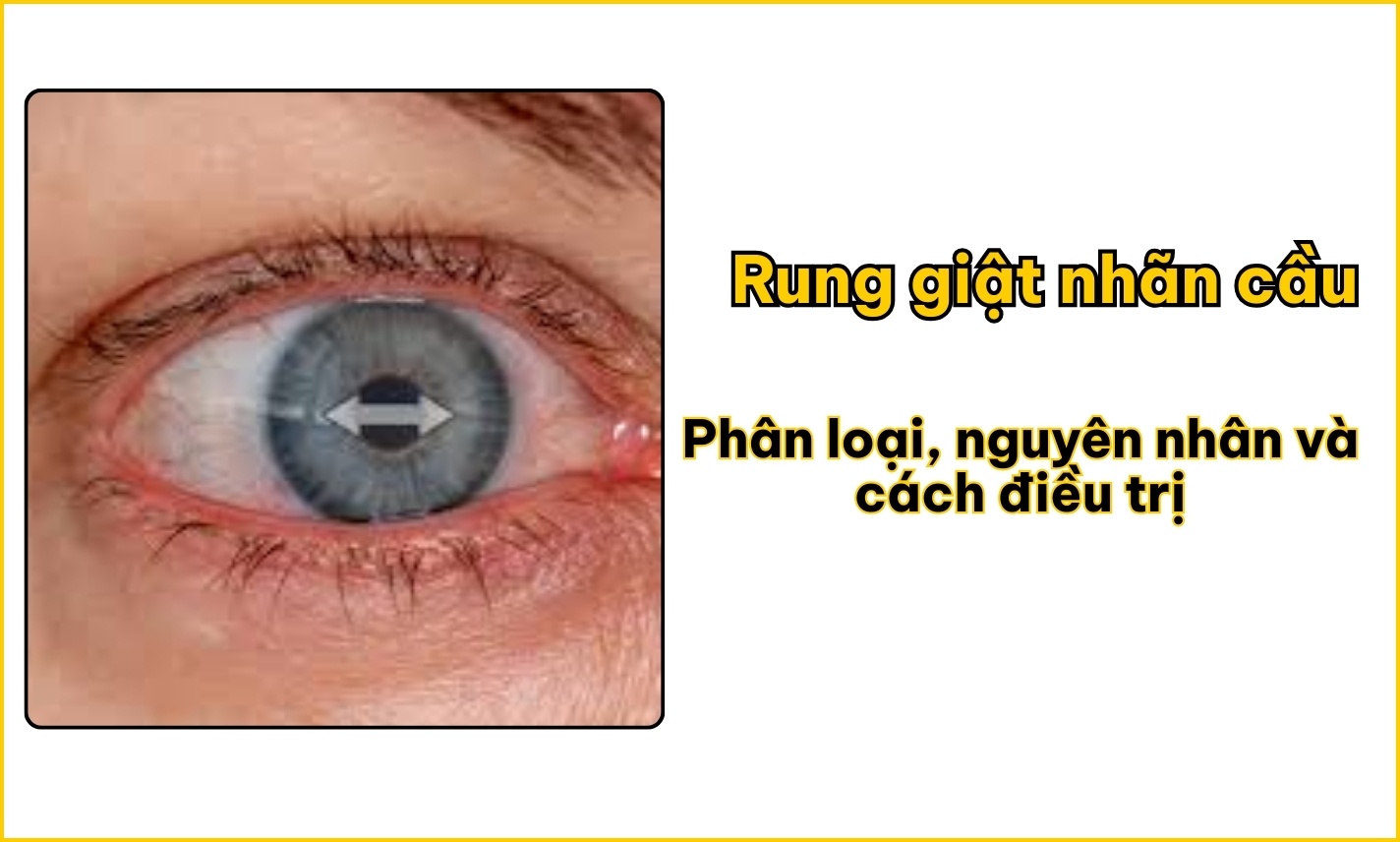 Rung giật nhãn cầu: Phân loại, nguyên nhân và cách điều trị