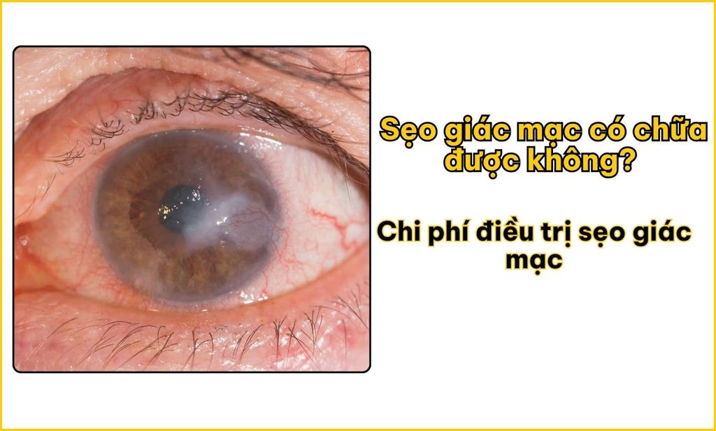 Sẹo giác mạc có chữa được không? Chi phí trị sẹo giác mạc