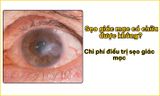 Sẹo giác mạc có chữa được không? Chi phí trị sẹo giác mạc