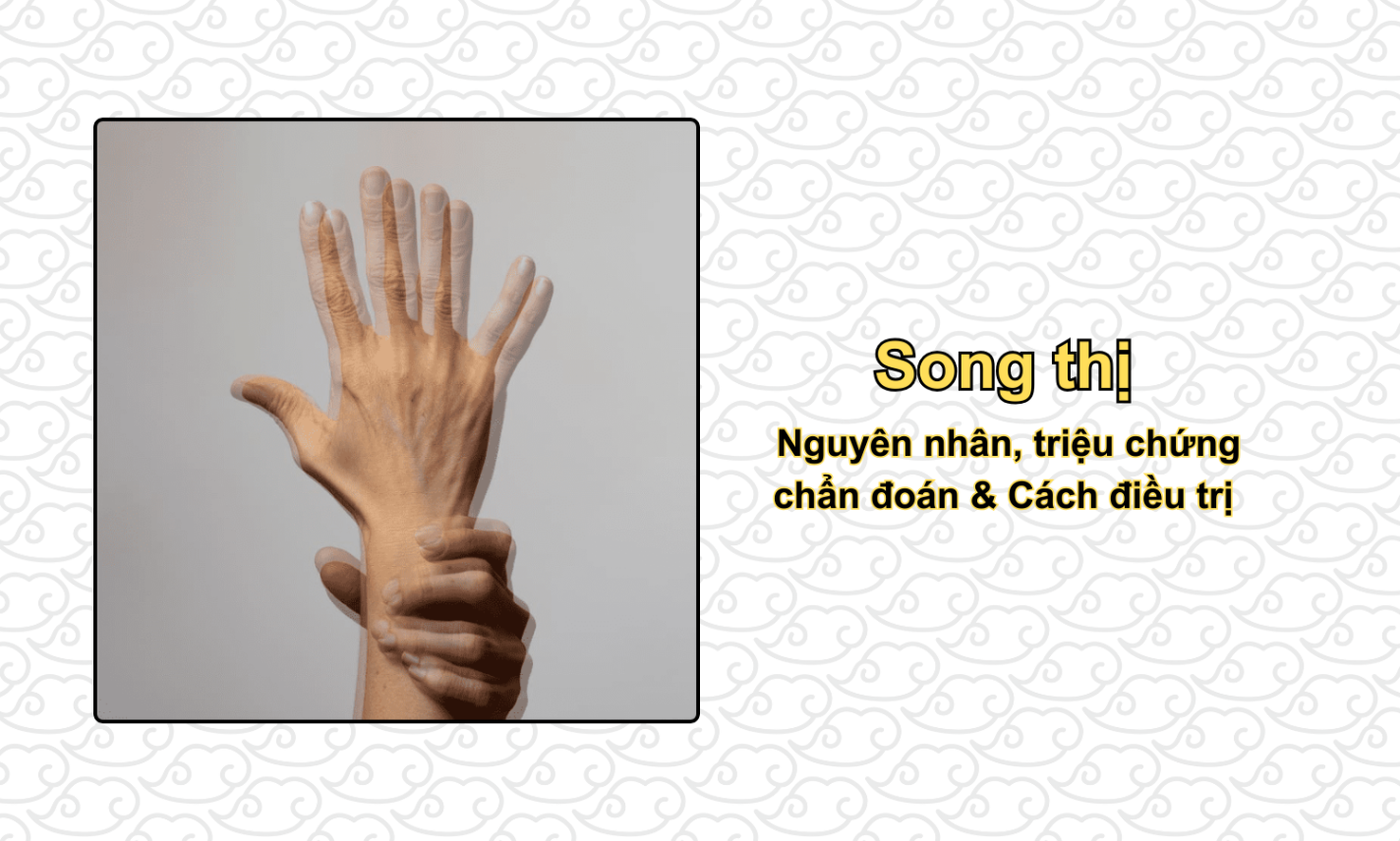 Song thị: Nguyên nhân, triệu chứng, chẩn đoán & Cách điều trị