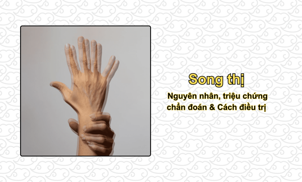 Song thị: Nguyên nhân, triệu chứng, chẩn đoán & Cách điều trị