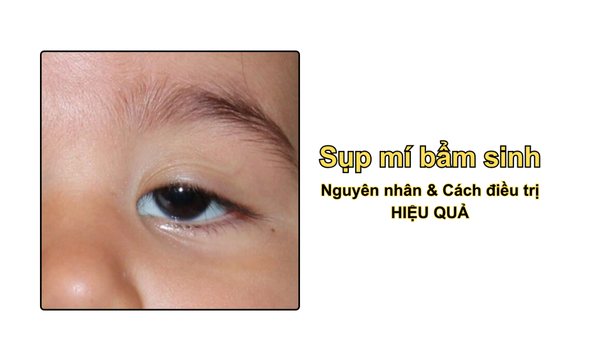 Sụp mí bẩm sinh: Nguyên nhân & Cách điều trị HIỆU QUẢ