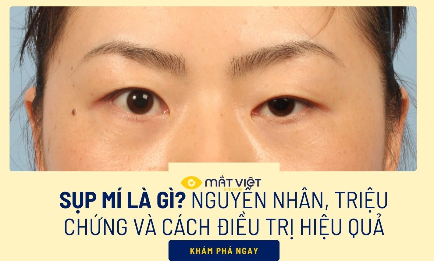 Sụp mí là gì? Nguyên nhân, triệu chứng và cách điều trị