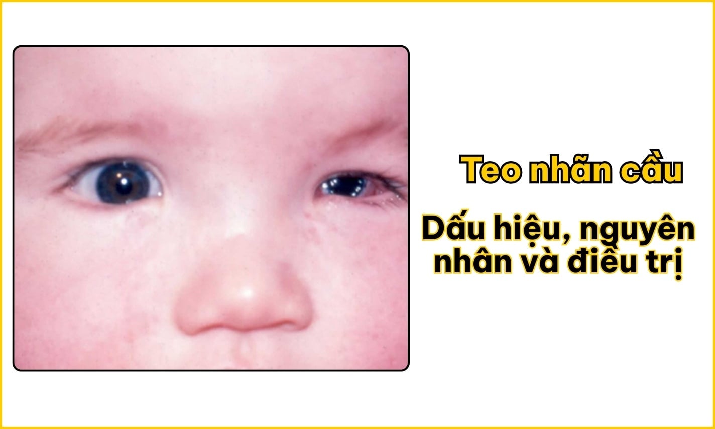 Teo nhãn cầu: Dấu hiệu, nguyên nhân và điều trị