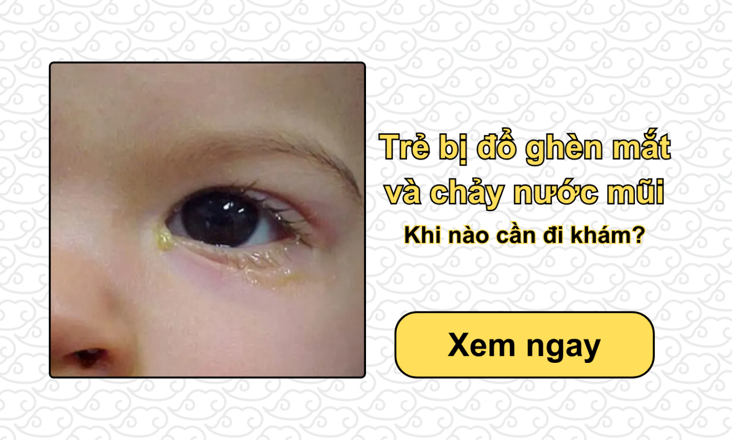 Trẻ bị đổ ghèn mắt và chảy nước mũi: Khi nào cần đi khám?