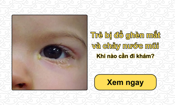 Trẻ bị đổ ghèn mắt và chảy nước mũi: Khi nào cần đi khám?