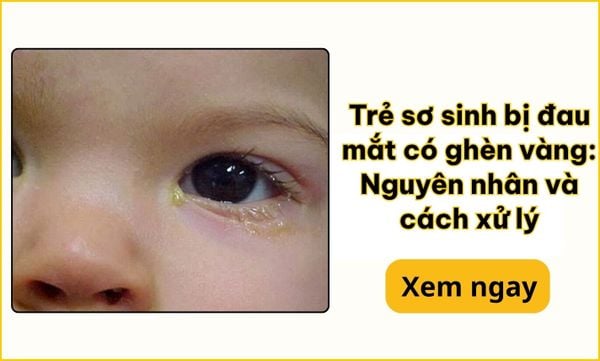 Trẻ sơ sinh bị đau mắt có ghèn vàng: Nguyên nhân & xử lý