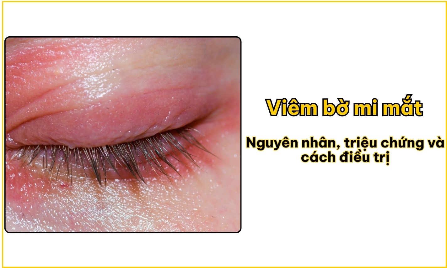 Viêm bờ mi mắt: Nguyên nhân, triệu chứng và cách điều trị