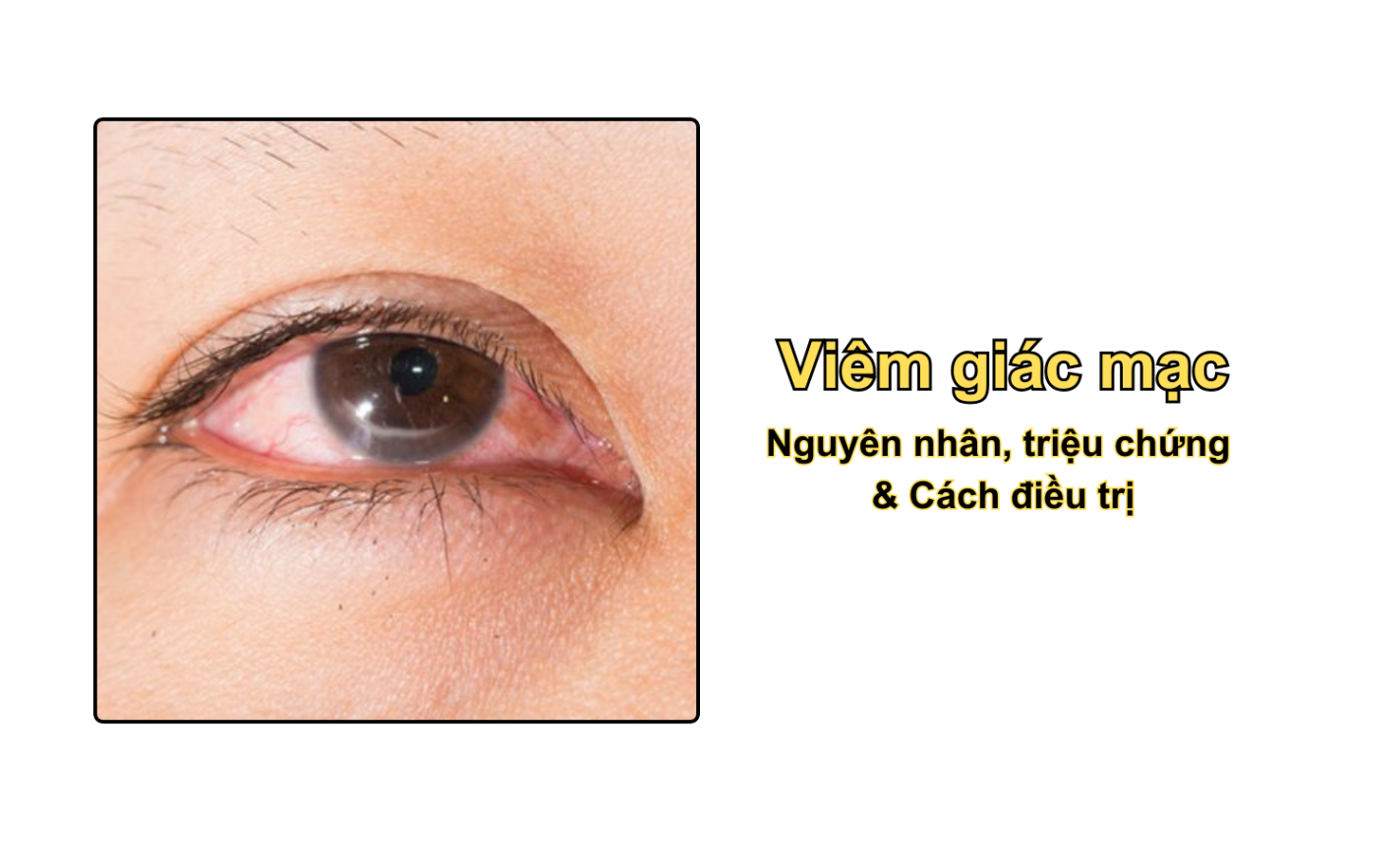 Viêm giác mạc: Nguyên nhân, triệu chứng & Cách điều trị