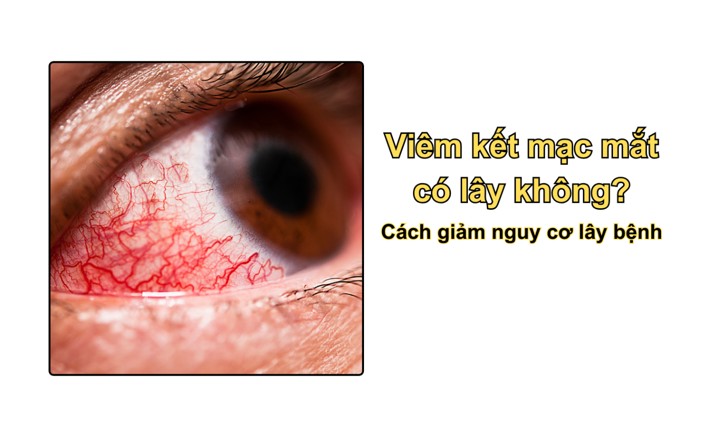 Viêm kết mạc mắt có lây không? Cách giảm nguy cơ lây bệnh