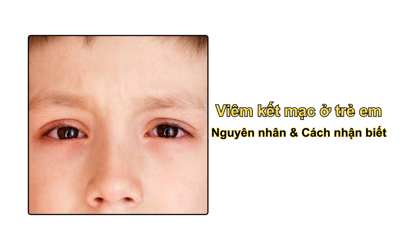 Viêm kết mạc ở trẻ em: Nguyên nhân & Cách nhận biết