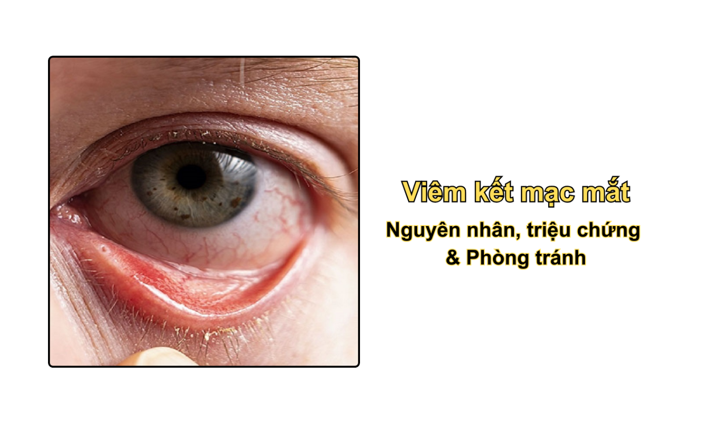 Viêm kết mạc mắt: Nguyên nhân, triệu chứng & Phòng tránh