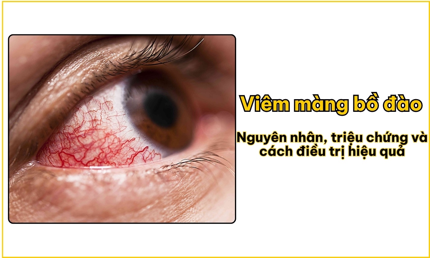 Viêm màng bồ đào: Nguyên nhân, triệu chứng và cách điều trị